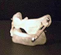 Orthodontic dental device to bring lower jaw forward